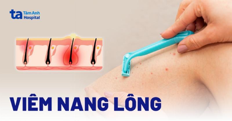 Hình ảnh minh họa các dạng khác nhau của viêm nang lông nách (vi khuẩn, nấm, lông mọc ngược).